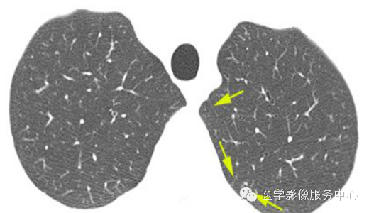 ?肺部HRCT标准化术语词汇( 图文详解)