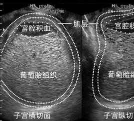 15岁少女 怀上罕见"葡萄胎 发生了什么?