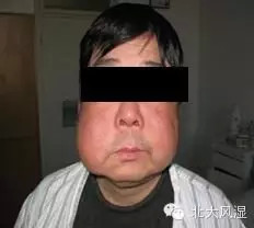 干燥综合征腮腺肿大返回搜狐,查看更多