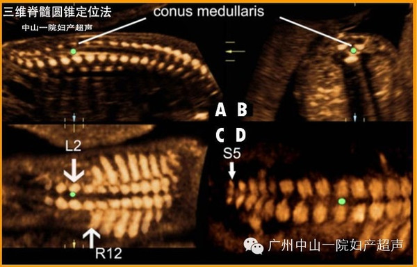 准确定位胎儿脊髓圆锥简易三维超声技术