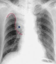 临床常用的五大肺癌诊断影像学检查