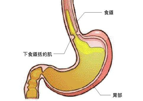 胃“反酸”及时中医治疗，预防食管癌胃癌的发生-搜狐