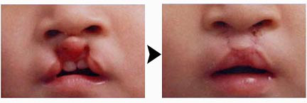 唇腭裂矫正术,多科室权威专家根据患儿不同年龄阶段的唇腭裂表现特征