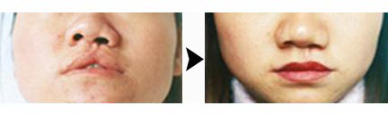 2,鼻畸形整复术 唇裂术后患者往往伴有不同程度鼻畸形,即裂侧鼻孔