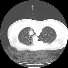 肺部肿瘤如何确诊?