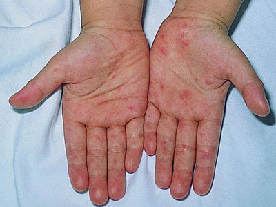 如何鉴别水痘与手足口病?预防宝宝手足口病1
