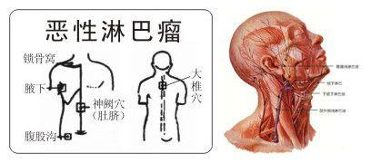 郑州希福中医肿瘤医院的院长袁希福提醒我们:淋巴癌骨转移治疗的目的