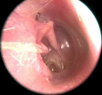 耳膜为什么会内陷,对听力有什么影响?