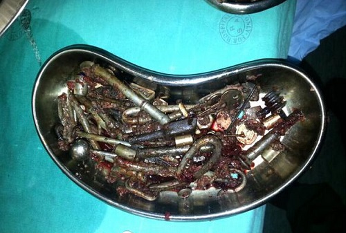 南非一男子吞下227个金属物件 胃部被填满(图