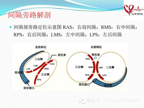 读书报告会——冠状窦口附近旁路消融中冠状动脉解剖的价值