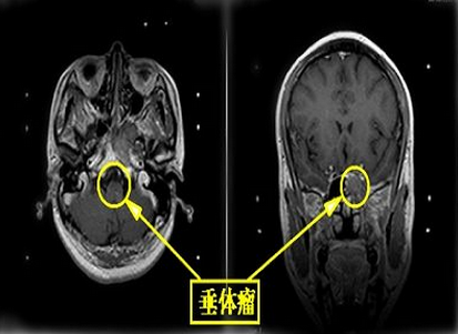 引领未来的技术——从鼻孔切除垂体腺瘤