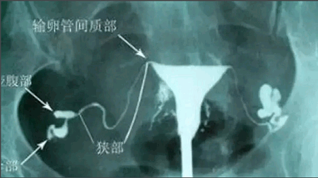 北京不孕不育医院专家解答输卵管造影疼不疼