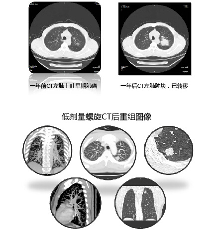 肺癌早筛 低剂量CT是关键