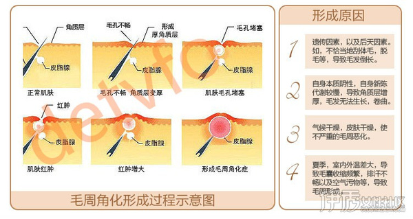 身上胳膊上的鸡皮肤怎么消除