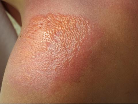 日光性皮炎是春夏常见的一种皮肤病,俗称晒斑或紫外线过敏.