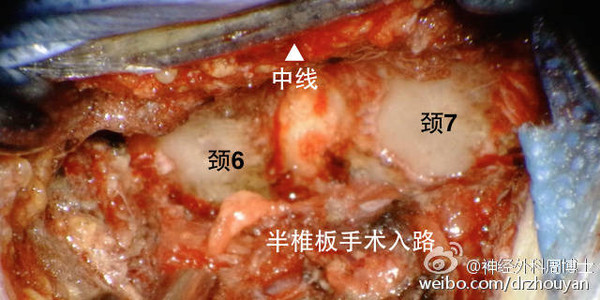 用椎板咬骨钳去除棘突基底内侧的骨质,扩大空间,直至显露硬脊膜囊的对