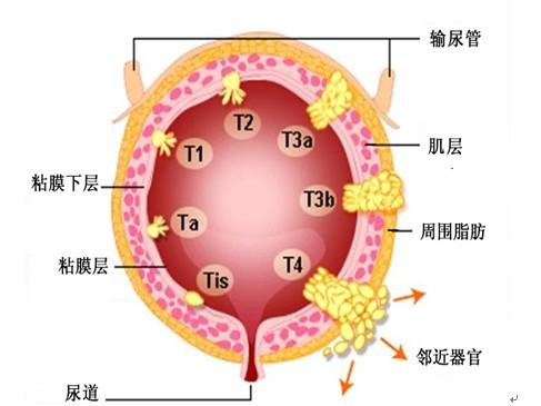 不同药物行膀胱灌注防治膀胱癌的临床观察与护理体会