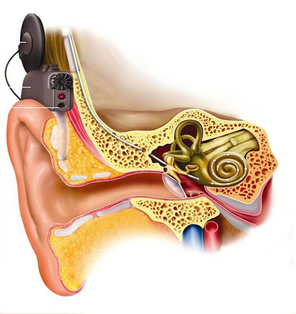 打算给孩子做人工耳蜗,手术风险有多大?