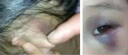 女童小婷婷雙眼腫得兇猛,耳朵和背面也有淤青。