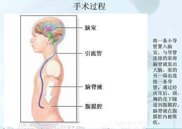 不足一岁幼儿脑积水慎用脑室镜