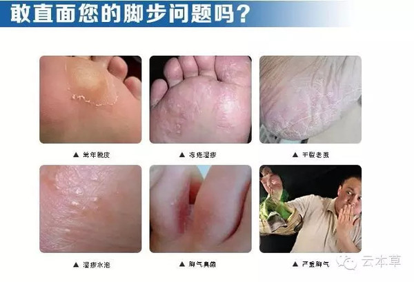 引起脚臭的罪魁祸首是一种叫白癣菌的真菌,也就是通常说的香港脚菌,它