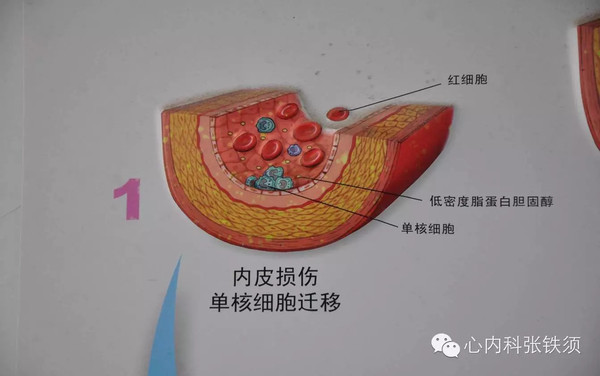 高考与动脉硬化