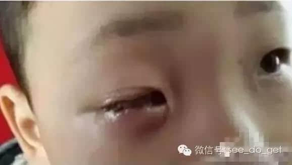 5岁男童玩干燥剂把眼睛炸伤 眼珠被溶解