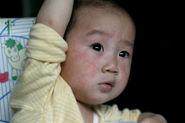 幼儿各种疹子的症状及护理