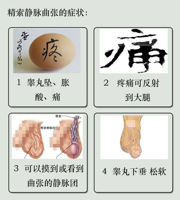 精索静脉曲张会导致不生孩子吗?