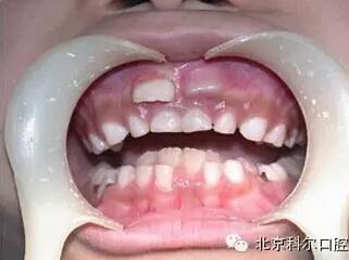 【多生牙】我们一起了解一下什么是多生牙齿?