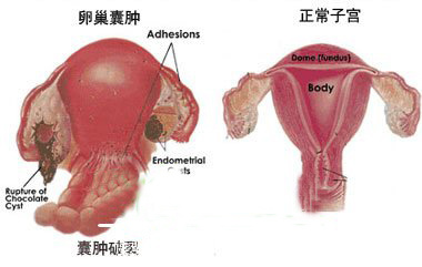 北京不孕不育医院专家谈妇科肿瘤的病因及预防