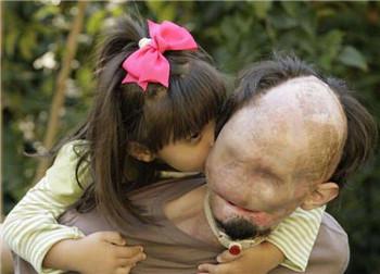 没有脸的爸爸,他受伤的原因让女儿觉得他是天