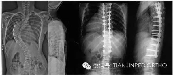 天津医院小儿骨科脊柱畸形矫正策略