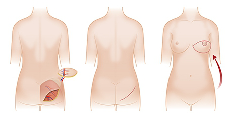 专家介绍乳房再造三种手术方法