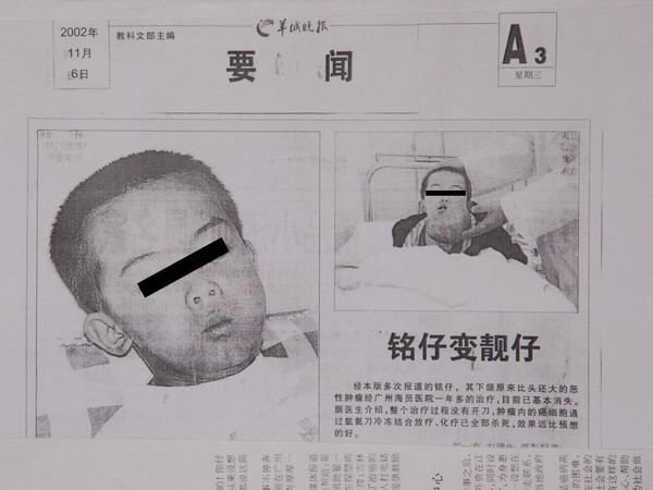 广州复大医院恶性畸胎瘤康复患者独白