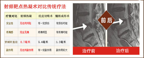 上海看颈椎病医院_颈椎病的治疗方法