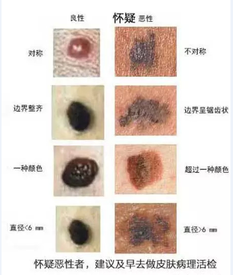 2,常见的皮肤良性肿瘤——色素痣
