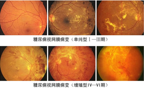 6.糖尿病视网膜病变分几种类型?
