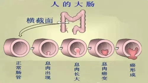 80%肠息肉易致癌 肠镜检查防微杜渐-搜狐健康