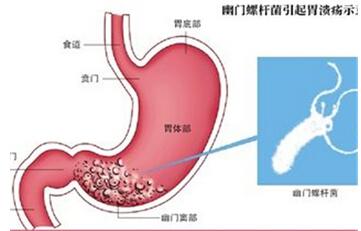 幽门螺杆菌是什么?爱护宝宝从了解开始