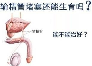 北京男科医院谈输精管堵塞的原因及治疗