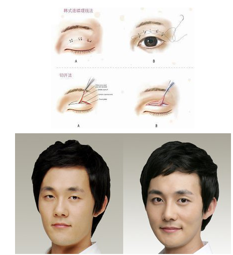 男士双眼皮展现阳刚魅力