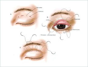 【Yestar】双眼皮整形常见的方法