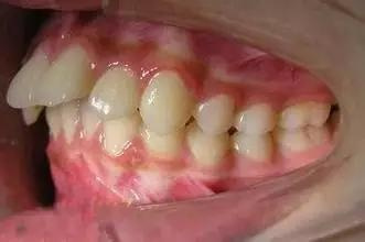 替牙期严重的牙齿拥挤.