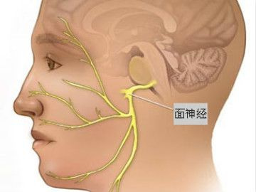 这种疾病的出现主要是因为患者的面神经受损引发的,面神经的损伤目前