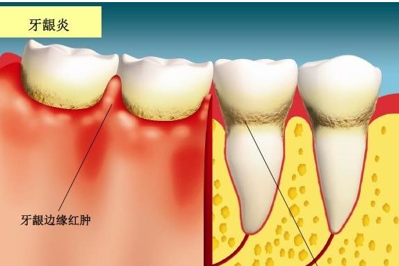 神奇!看中医如何治疗牙龈炎!