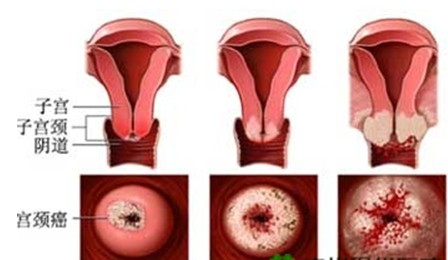 宫颈癌的分类及治疗原则