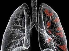 肺癌晚期的症状表现,以及护理注意事项