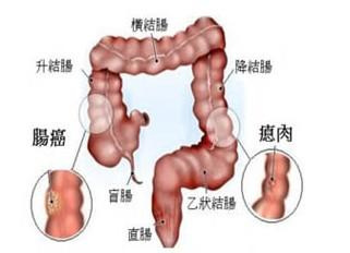 早期直肠癌有什么症状