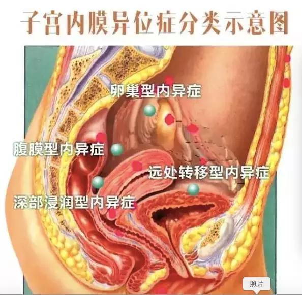 北京不孕不育医院教你认识"诡异"子宫内膜异位症